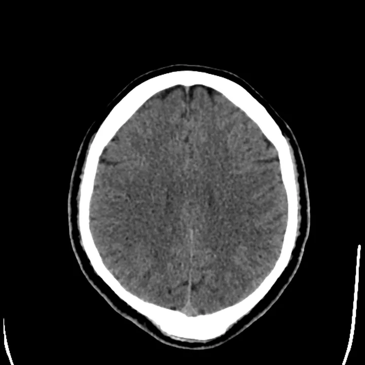 Corte axial de tomografia de crânio ao nível dos ventrículos laterais, em janela de encéfalo, mostrando a substância cinzenta e branca e a linha média.