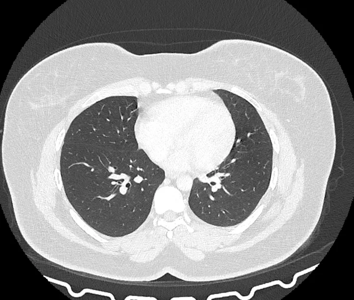 Corte axial de tomografia de tórax em janela de pulmão, mostrando o parênquima pulmonar, os vasos e as vias aéreas dos dois pulmões, com o mediastino em branco no centro.