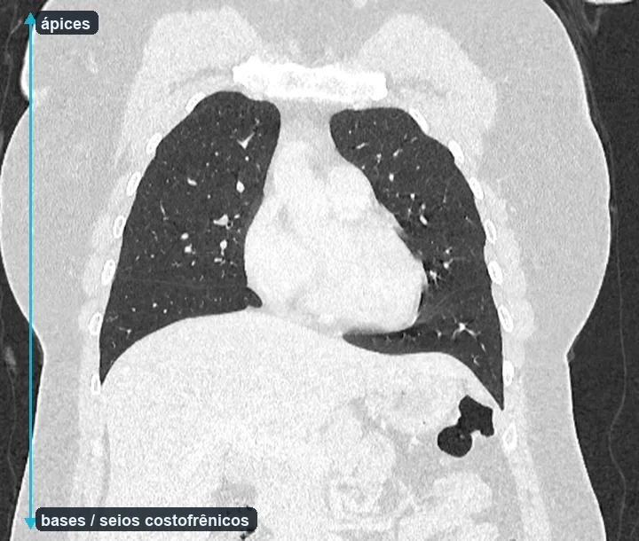 Reformatação coronal de uma tomografia de tórax, mostrando os dois pulmões dos ápices até as bases, com uma seta vertical indicando os limites superior e inferior da cobertura.
