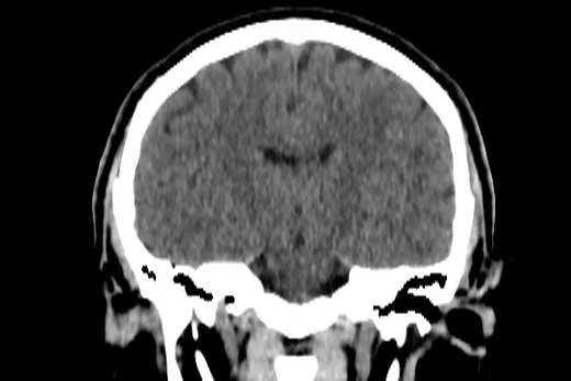 Reformatação coronal de uma tomografia de crânio adquirida em cortes finos de 1 mm, mostrando a calota, a base do crânio e o parênquima cerebral com boa nitidez.