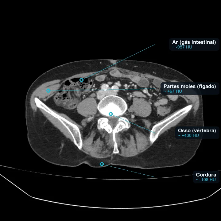 Corte axial de tomografia de abdome com quatro regiões de interesse marcadas e seus valores de HU: gás intestinal cerca de menos 957, gordura cerca de menos 108, partes moles do fígado cerca de mais 67 e osso da vértebra cerca de mais 430.