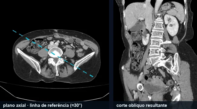 À esquerda, um corte axial de abdome com uma linha de referência tracejada inclinada a cerca de 30 graus; à direita, a imagem oblíqua reconstruída ao longo dessa linha, mostrando a coluna, os rins e o fígado em um único plano.