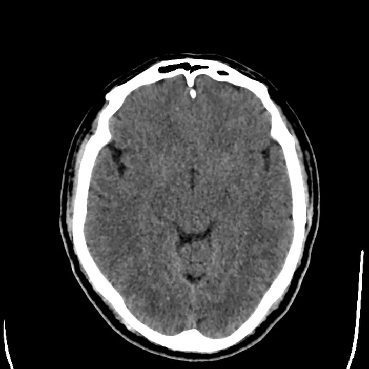 Corte axial (transversal) de tomografia de crânio em janela de encéfalo, mostrando o parênquima cerebral, os ventrículos e a calota óssea.