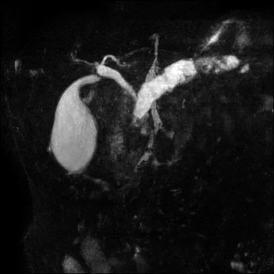 MRCP (colangiorressonância) em projeção MIP coronal: a vesícula biliar brilhante à esquerda, o ducto cístico, o colédoco descendo e o ducto pancreático, todos claros sobre o fundo escuro.