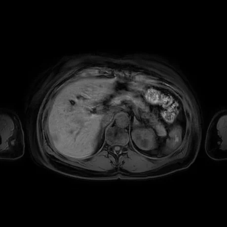 RM axial do abdome superior ponderada em T1 com saturação de gordura, mostrando o fígado, o baço, o estômago e o leito pancreático anterior aos vasos esplênicos.