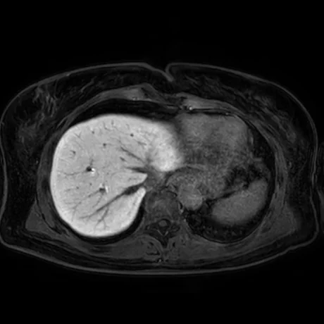RM axial do abdome na fase hepatobiliar após gadoxético (Primovist), com o fígado realçado (claro) e os vasos hepáticos e a árvore biliar escuros.