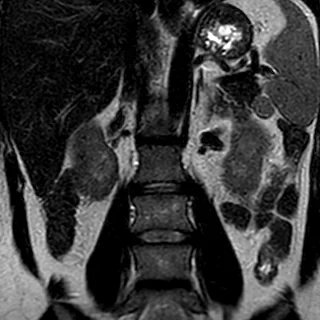 RM coronal fortemente ponderada em T2 (urográfica) do abdome, mostrando os dois rins com o parênquima e o sistema coletor, a coluna ao centro e o líquido brilhando sobre o fundo escuro.