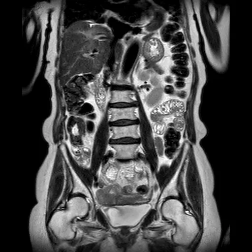 RM coronal T2 do abdome total mostrando, num só plano, o fígado, o baço, os dois rins, as alças intestinais, a coluna ao centro e a pelve com a bexiga embaixo.