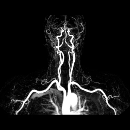 Angio-RM (MIP) das artérias cervicais em projeção frontal: o arco aórtico embaixo, as carótidas comuns subindo e se bifurcando em interna e externa, as artérias vertebrais laterais e o polígono de Willis na base do crânio.
