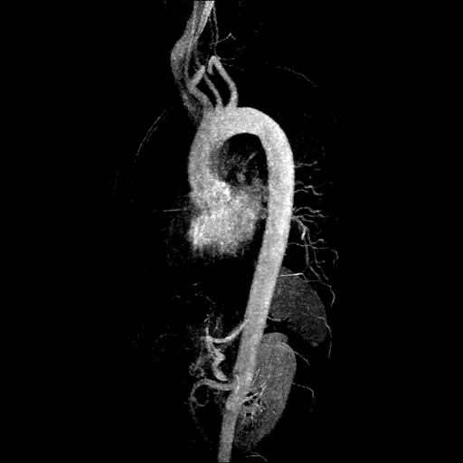 Angio-RM (MIP) da aorta torácica em visão sagital do arco: a raiz e a aorta ascendente, o arco com os ramos da base do pescoço no alto e a aorta descendente formando o cajado.