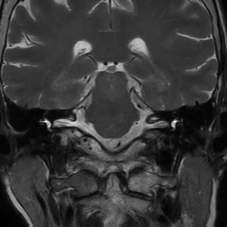 RM coronal fortemente ponderada em T2 com saturação de gordura através dos condutos auditivos internos, com o líquor claro na base do crânio marcando as cisternas e os CAI simétricos dos dois lados.