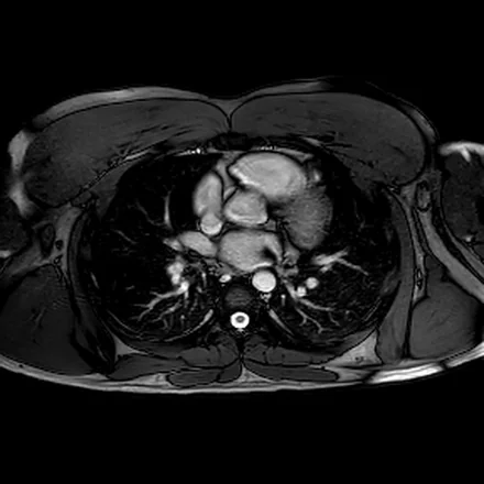 RM cardíaca, imagem de sangue-claro (SSFP) em corte axial mostrando as câmaras cardíacas com o sangue hiperintenso e o miocárdio ao redor.