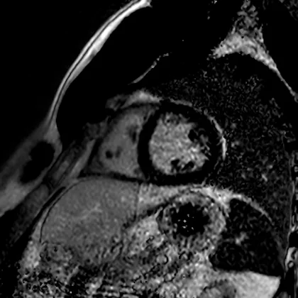 RM cardíaca em eixo curto do ventrículo esquerdo, mostrando o anel de miocárdio em volta da cavidade ventricular e o ventrículo direito.