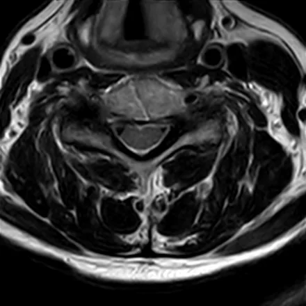 RM axial T2 da coluna cervical ao nível de um disco, mostrando a medula com o líquor ao redor, os forames de conjugação e o disco.