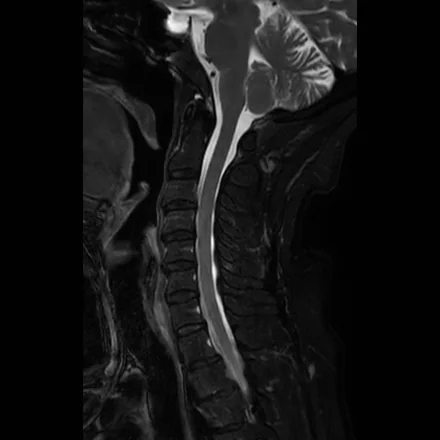 RM sagital mediana T2 da coluna cervical, com a medula, os discos e o líquor claro da transição craniocervical à torácica alta.
