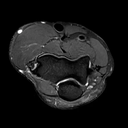 RM axial do cotovelo ponderada em T2 com saturação de gordura ao nível da articulação, mostrando o úmero distal, os tendões e a região do túnel cubital atrás do epicôndilo medial.