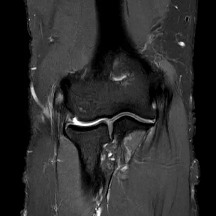 RM coronal do cotovelo ponderada em T2 com saturação de gordura, mostrando a tróclea e o capítulo do úmero, a articulação e os epicôndilos com os tendões e ligamentos colaterais.