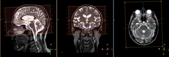 Tela real de planejamento do console de RM em três janelas: à esquerda a sagital com os cortes axiais planejados (linhas paralelas cobrindo do vértice ao forame magno, alinhadas à linha do corpo caloso), ao centro a coronal e à direita a axial.