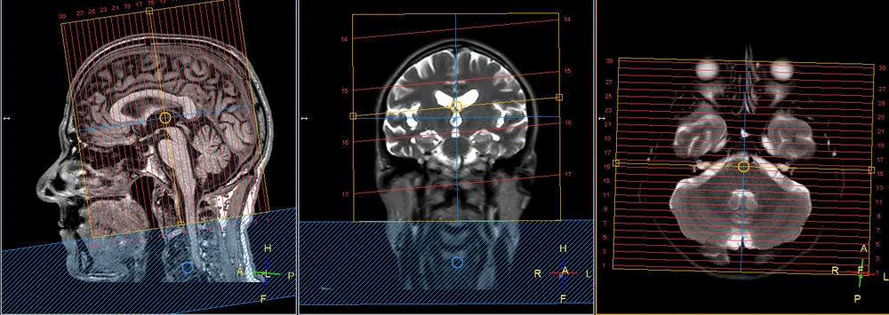 Tela real de planejamento do console de RM em três janelas para as coronais: à esquerda a sagital com a angulação e a cobertura, ao centro a coronal de referência, à direita a axial com as coronais perpendiculares à linha média.