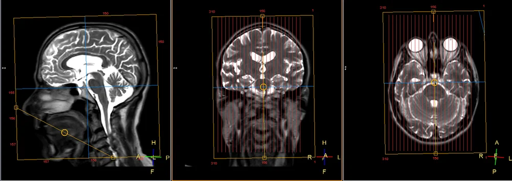 Tela real de planejamento do console de RM em três janelas para as sagitais: à esquerda a sagital de referência, ao centro a coronal e à direita a axial, com a caixa da aquisição sagital alinhada à linha média.