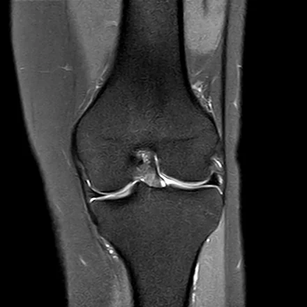 RM coronal do joelho ponderada em densidade de prótons com saturação de gordura, mostrando os côndilos femorais, o platô tibial, os meniscos medial e lateral e os ligamentos colaterais.