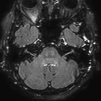 RM axial 3D FLAIR tardia após gadolínio ao nível do labirinto, mostrando o realce da perilinfa como sinal claro nos labirintos dos dois lados, sobre o fundo da fossa posterior.