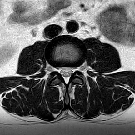 RM axial T2 da coluna lombar no nível de um disco: o saco tecal claro no centro com as raízes da cauda equina, os recessos laterais, os forames neurais e as articulações facetárias atrás.