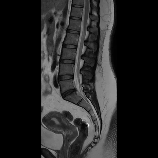 RM sagital T2 da coluna lombar: os corpos L1 a L5 e o sacro, os discos intervertebrais, o canal com o líquor claro, o cone medular e a cauda equina descendo no saco tecal.
