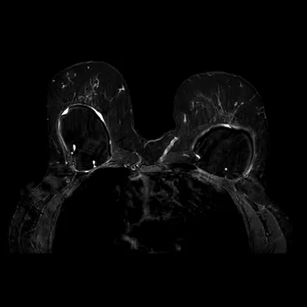 RM axial de mama ponderada em T2 com saturação de gordura, mostrando as duas mamas com próteses de silicone e o tecido fibroglandular.