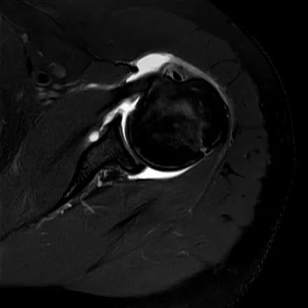 RM axial do ombro ponderada em T2 com saturação de gordura, mostrando a cabeça do úmero, a glenoide com o lábio anterior e posterior e o cabo longo do bíceps no sulco.