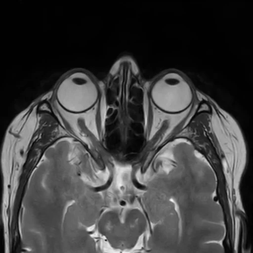 RM axial das órbitas com saturação de gordura: os dois globos oculares com o cristalino à frente, os nervos ópticos correndo para trás do globo ao ápice orbitário e a musculatura extraocular.