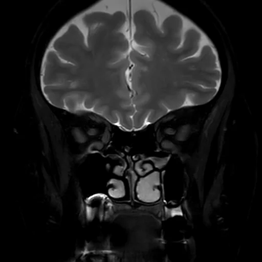 RM coronal T2 com saturação de gordura das órbitas: as duas órbitas lado a lado com os nervos ópticos e os músculos extraoculares, os seios etmoidais entre elas e os lobos frontais acima.
