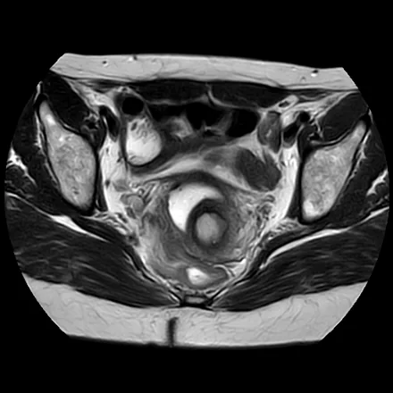 RM axial T2 de alta resolução da pelve feminina, mostrando o útero com a anatomia zonal (endométrio, zona juncional e miométrio) e as estruturas vizinhas.