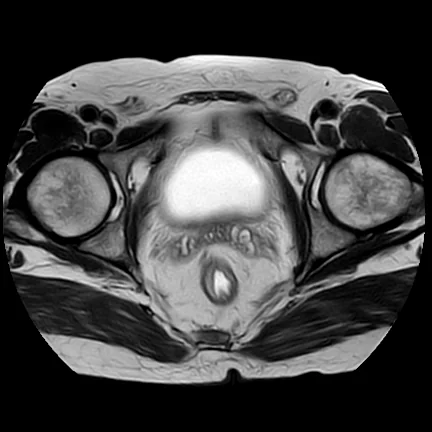 RM axial T2 da pelve feminina mostrando o útero com sua anatomia zonal no centro, as regiões anexiais de cada lado, a bexiga à frente e o reto atrás.
