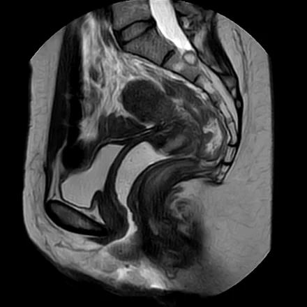 RM sagital mediana T2 da pelve feminina, mostrando o útero com anatomia zonal, o colo, a bexiga à frente e o reto atrás.