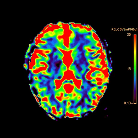 Mapa colorido de volume sanguíneo cerebral relativo (rCBV) em corte axial ao nível dos núcleos da base, com a substância cinzenta cortical e os núcleos da base em vermelho e amarelo (alto volume) e a substância branca em azul e verde (baixo volume), com uma barra de escala de cor à direita.
