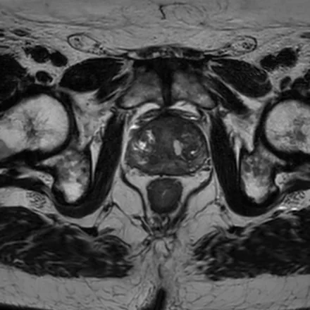 RM axial T2 de alta resolução da próstata, mostrando a anatomia zonal (zona periférica mais clara e glândula central mais escura).