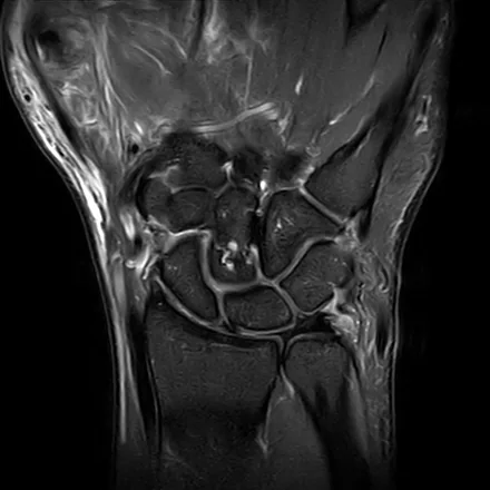 RM coronal do punho ponderada em T2 com saturação de gordura, mostrando os ossos do carpo, o rádio e a ulna distais e a região da fibrocartilagem triangular.