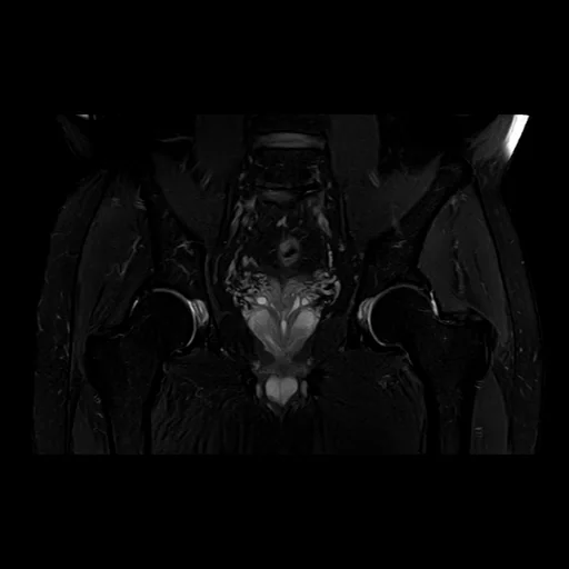 RM coronal com saturação de gordura da pelve mostrando os dois quadris de frente: as duas cabeças femorais nos acetábulos, os colos e os trocânteres, num campo largo que compara os dois lados.