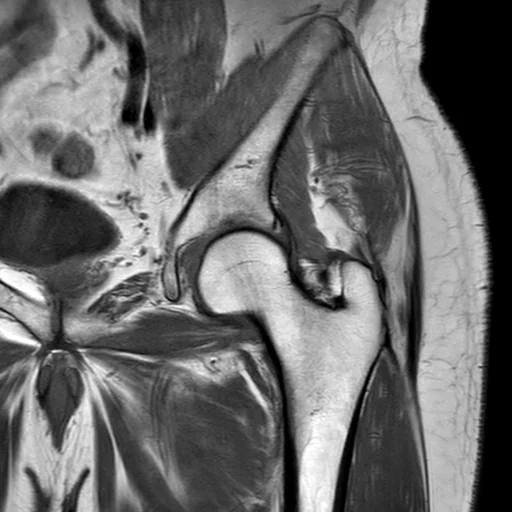 RM coronal de alta resolução de um quadril: a cabeça femoral esférica encaixada no acetábulo, o lábio acetabular como um pequeno triângulo na borda superior, o colo femoral e o grande trocânter.