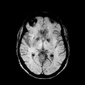 RM axial de suscetibilidade SWI