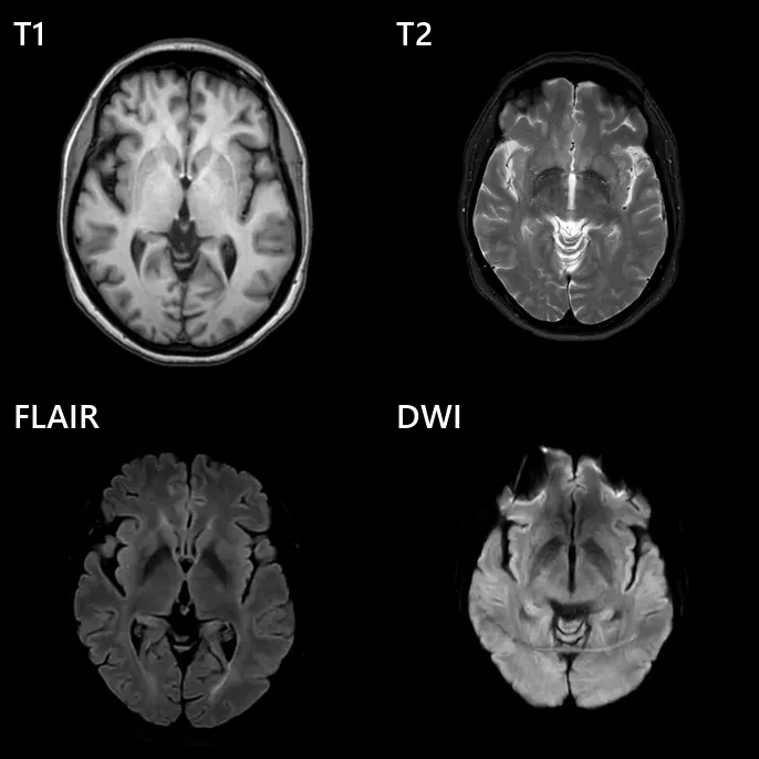 Quatro imagens axiais do mesmo nível do encéfalo em ressonância magnética, rotuladas T1, T2, FLAIR e DWI, mostrando como o contraste da mesma anatomia muda conforme a sequência.