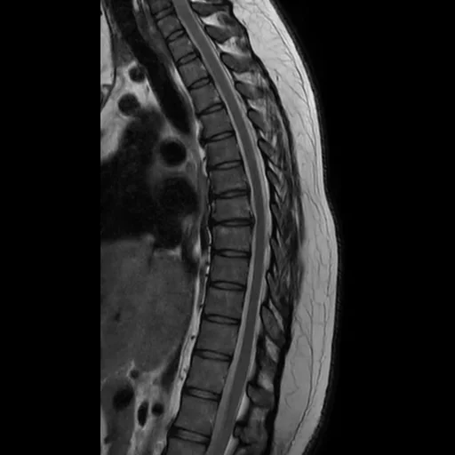 RM sagital T2 da coluna torácica: os corpos vertebrais T1 a T12 empilhados, os discos intervertebrais, a medula espinhal cinzenta com o líquor claro em volta dentro do canal, até o cone medular.