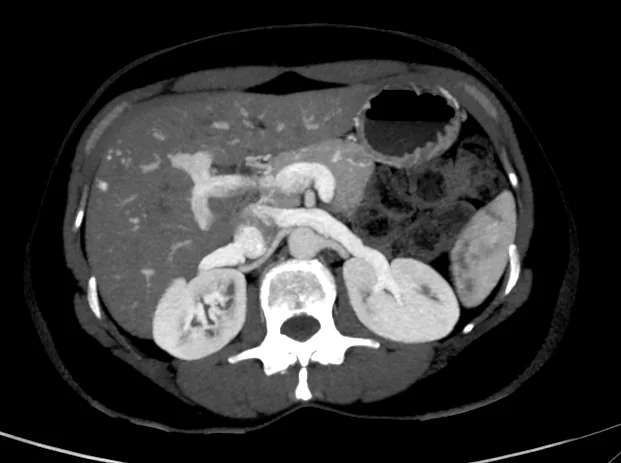 Corte axial de tomografia do abdome superior após contraste iodado intravenoso: rins realçados e brilhantes, fígado e baço com boa textura, aorta e veia cava opacificadas à frente da coluna.