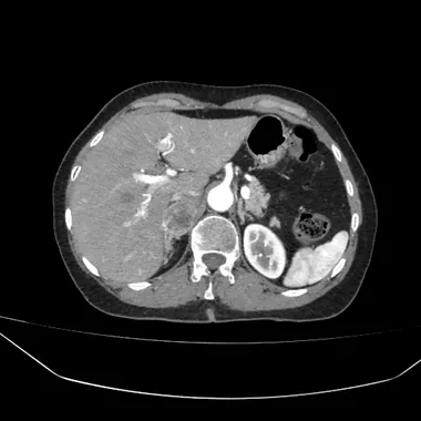 Fase arterial: aorta muito brilhante e baço com realce heterogêneo, mosqueado; o fígado ainda pouco realçado.