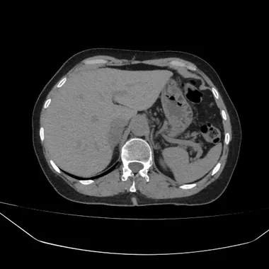 TC de abdome axial sem contraste: fígado, baço e aorta em densidade uniforme; a aorta tem a mesma densidade do músculo.