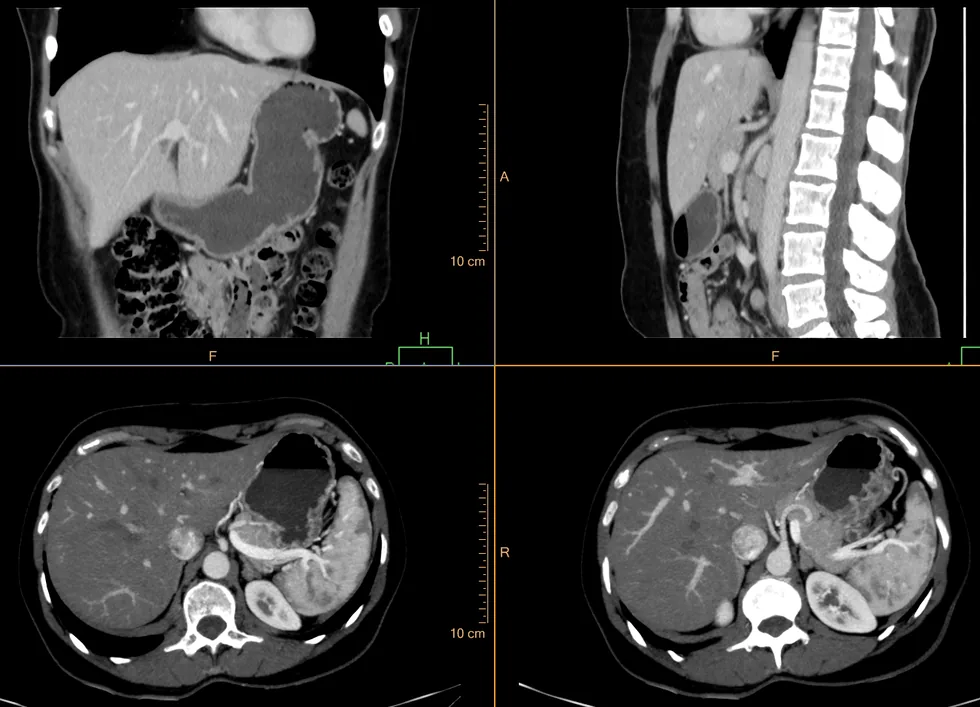 Reconstrução multiplanar de uma TC de abdome com contraste: painel coronal no alto à esquerda com fígado, rins e coluna; painel sagital no alto à direita com a aorta à frente da coluna; e dois cortes axiais na parte de baixo mostrando fígado, estômago, baço, aorta, veia cava e vértebra.