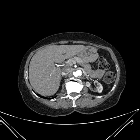 TC axial na fase arterial ao nível do abdome superior: a aorta e a artéria mesentérica superior aparecem como estruturas redondas muito brancas (contraste), à frente da coluna.
