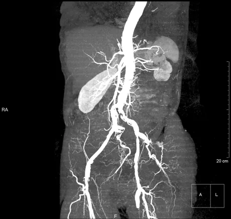 MIP frontal da aorta abdominal mostrando a aorta, o tronco celíaco, a mesentérica superior, as artérias renais e a bifurcação em ilíacas comuns, externas e internas até as femorais.