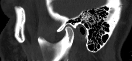 TC sagital oblíqua da ATM em janela óssea, mostrando o côndilo mandibular, a fossa glenoide, a eminência articular e as células aéreas da mastoide.